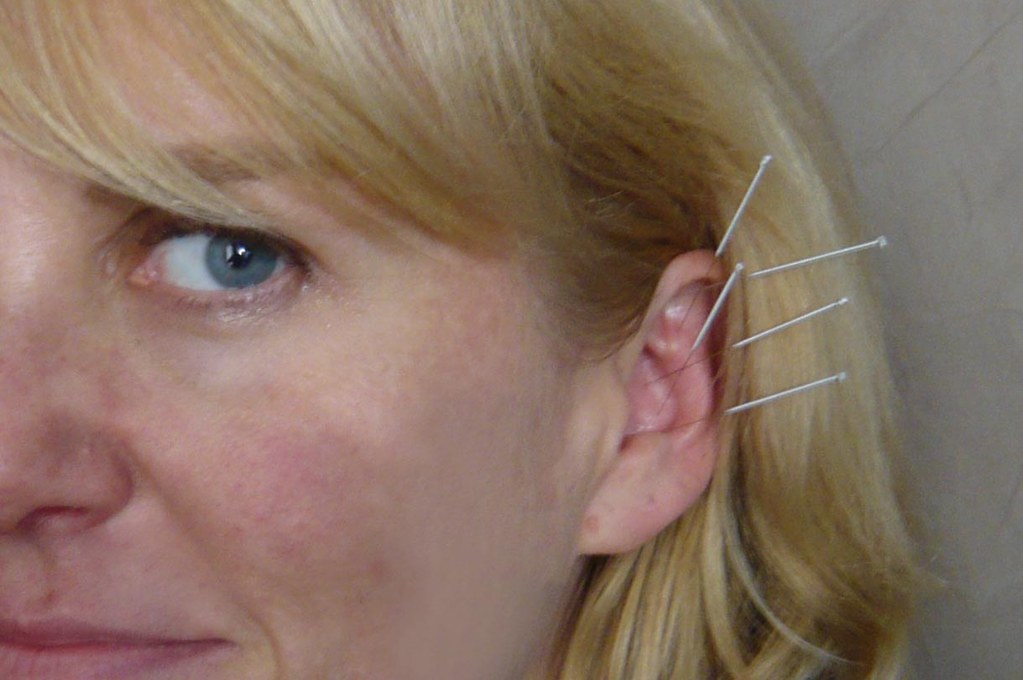 acupuntura auricular